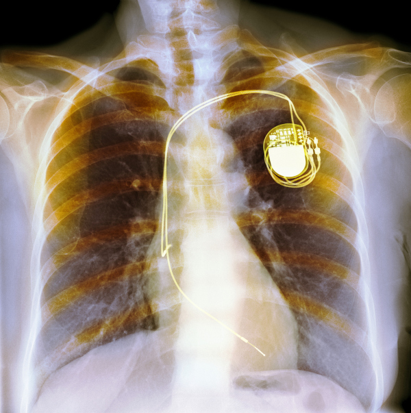 Dual chamber pacemaker. Coloured X-ray of the chest of a patient with a dual chamber pacemaker (top right). Wires lead from the device to both the right atrium and right ventricle of the heart. They supply electrical impulses that keep the heart beating regularly.