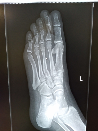 broken_foot